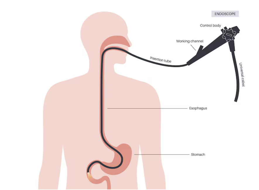 تشخيص الارتجاع الحمضي (مرض الجزر المعدي المريئي)